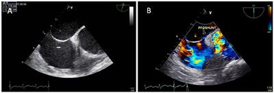 Transjugular Approach to Closure of Patent Foramen Ovale Under the Guidance of Fluoroscopy and Transthoracic Echocardiography: A Case Report